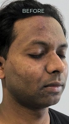 Before Dull Complexion