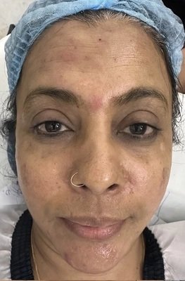 Before Dermal Fillers